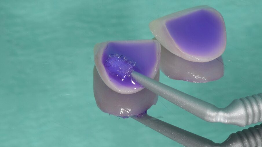 Cleaning metal-free fixed dental restorations prior to bonding procedures_Fig.5
