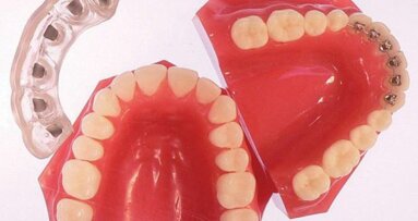 Simpli5 : la prochaine génération du traitement orthodontique invisible