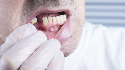 FDI releases new guidelines on treating partially dentate patients