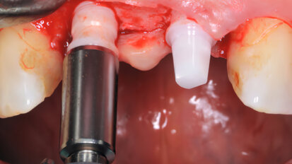 Bredent lansează a doua generație a implantului din zirconiu whiteSKY