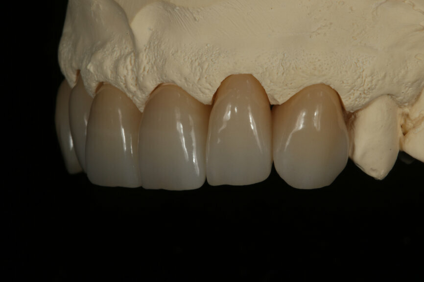 Fig. 7: Lateral view of the final restorations from the right.