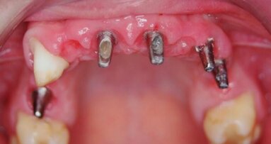 Leczenie implantoprotetyczne braków zębowych w odcinku przednim
