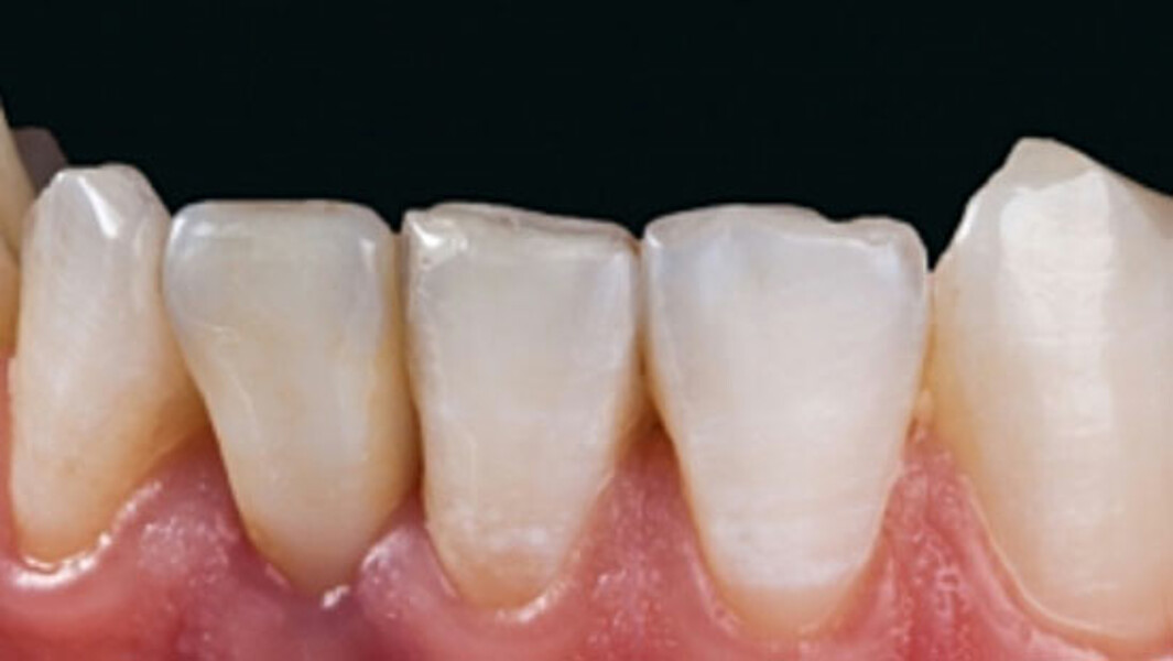Fig. 12. La corona de cerámica sin metal de VITA SUPRINITY PC se integró de manera excelente en la sustancia dental remanente en cuanto a la morfología y el color.