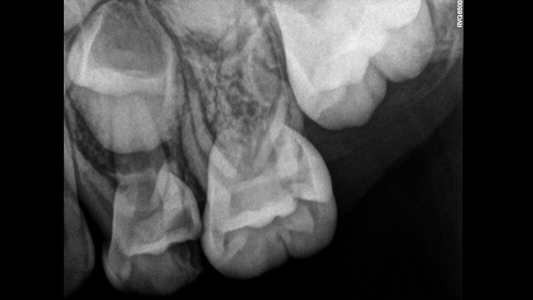 Fig. 20: Initial radiograph showing apical bone loss.