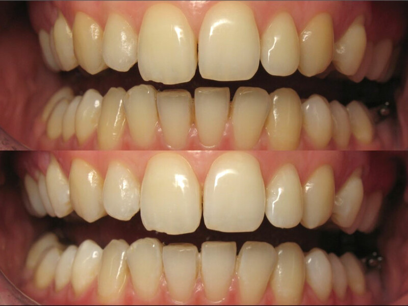 Figura 4. Antes y después del blanqueamiento dental en el consultorio de un paciente con tratamiento ortodóntico lingual.