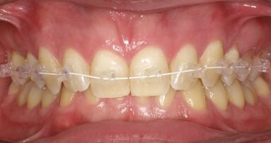 Nuovi traguardi ortodontici al servizio dell’estetica