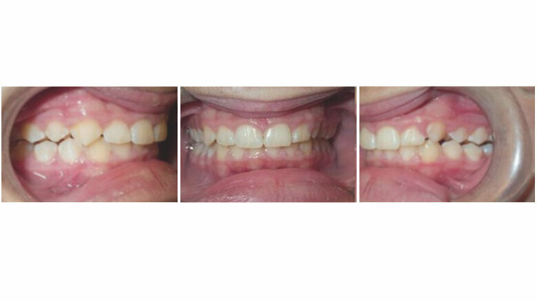 End of mandibular advancement phase after 11 months (initial aligners: U:27, L:27)