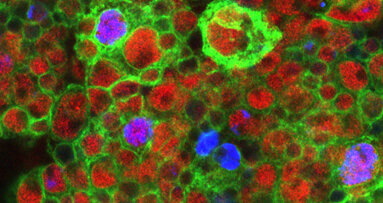 Stammzellen beeinflussen Tumorwachstum im Hirn