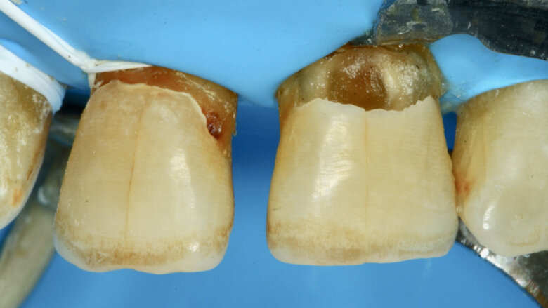 Figura 5. Eliminación de la dentina infectada utilizando curetas Maillefer.