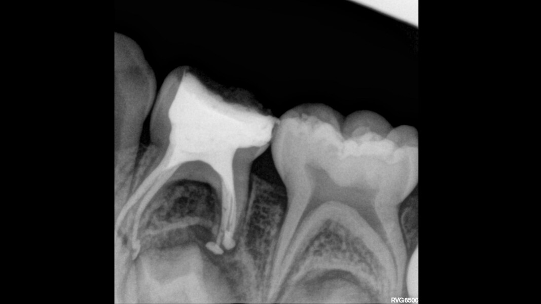 Fig. 16: Obturation of four root canals.