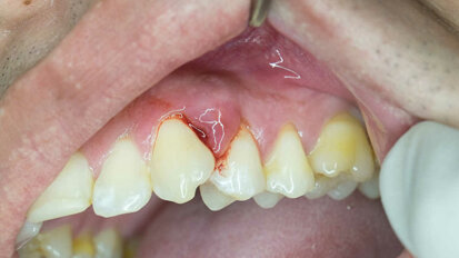 Pesquisadores desenvolvem tira e gel biodegradáveis para evitar perda óssea na periodontite