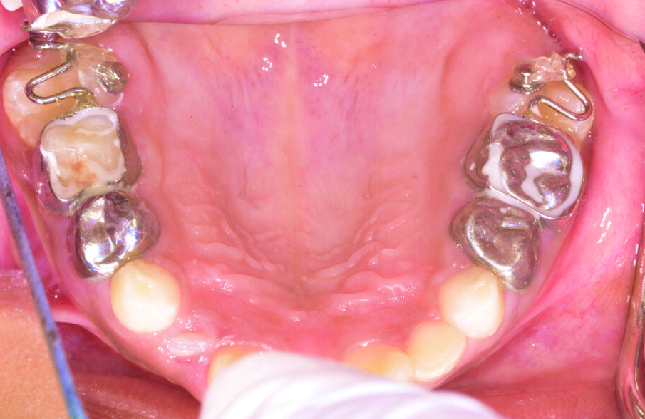 Figure 5: Bilateral ectopic eruption of the upper first permanent molars treated by a sling shot type appliance.