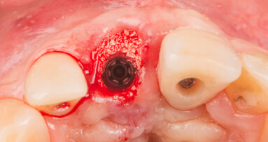 Immediate placement and restoration of a Straumann BLX implant replacing maxillary incisors