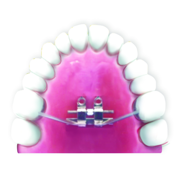 Fig.3 Bone- tooth anchored design: Only 2 anterior TADs and support of molars