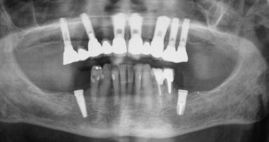 Les implants dentaires entraînent des risques de lésions nerveuses