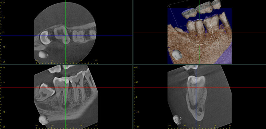 Fig. 15f: Cased treated with PIPs (Photon Induced Photoacoustic Streaming). Note the orifice barrier placed in composite to protect the endodontic treatment from coronal leakage. (Courtesy of Dr. Paula Elmi)