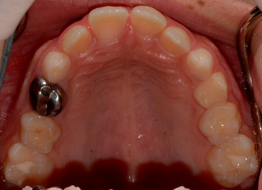 Figure 15: Palatal view of 21 one year on. Notice the excellent gingival healing.