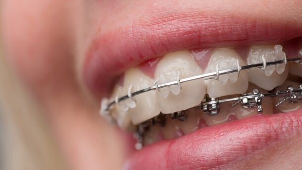 7 pytań o prostowanie zębów