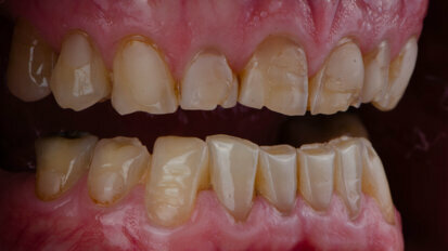 Research provides new insights into how acid damages teeth