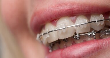 7 pytań o prostowanie zębów