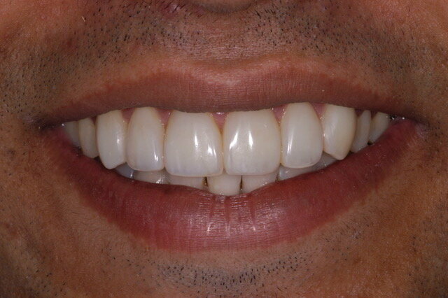 Fig 2B: Frontal smile view: After