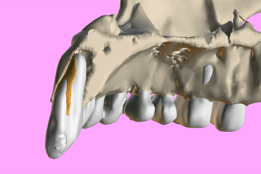 Fig. 4: The segmented root (white) and the root fragment (brown) within the sectioned maxillary surface model.