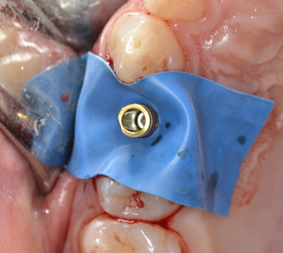 Fig. 15 - Protezione del sito chirurgico mediante un frammento di diga sterile prima di effettuare la ribasatura della corona provvisoria.