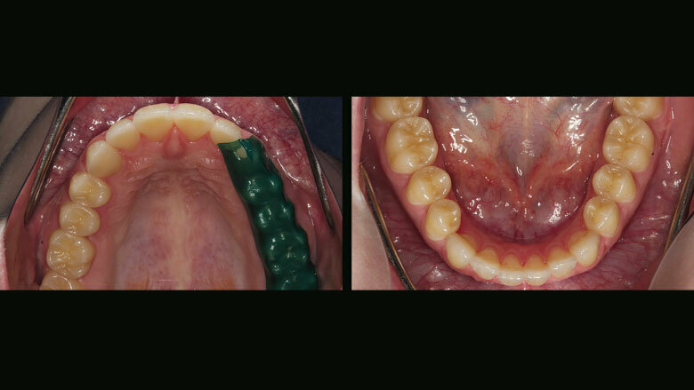 Figure 16: Examination of the dynamic occlusion using an occlusal indicator wax