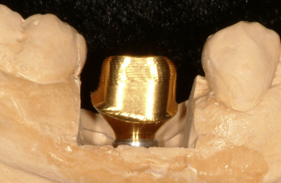 Fig. 12: The subgingival portion of the abutment would give the anatomical shape, support and
colour to the surrounding soft tissue. The definitive crown restoration in zirconia
was fabricated.