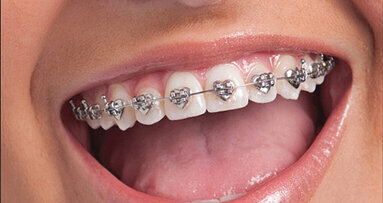 Kids can go ‘wild’ for multi-shaped braces