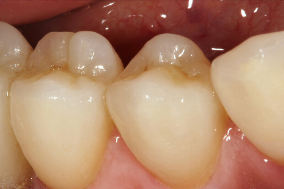 Fig. 20: The combination of areas with monolithic zirconia and areas with buccal veneering combines the entirely different advantages of two ceramics.