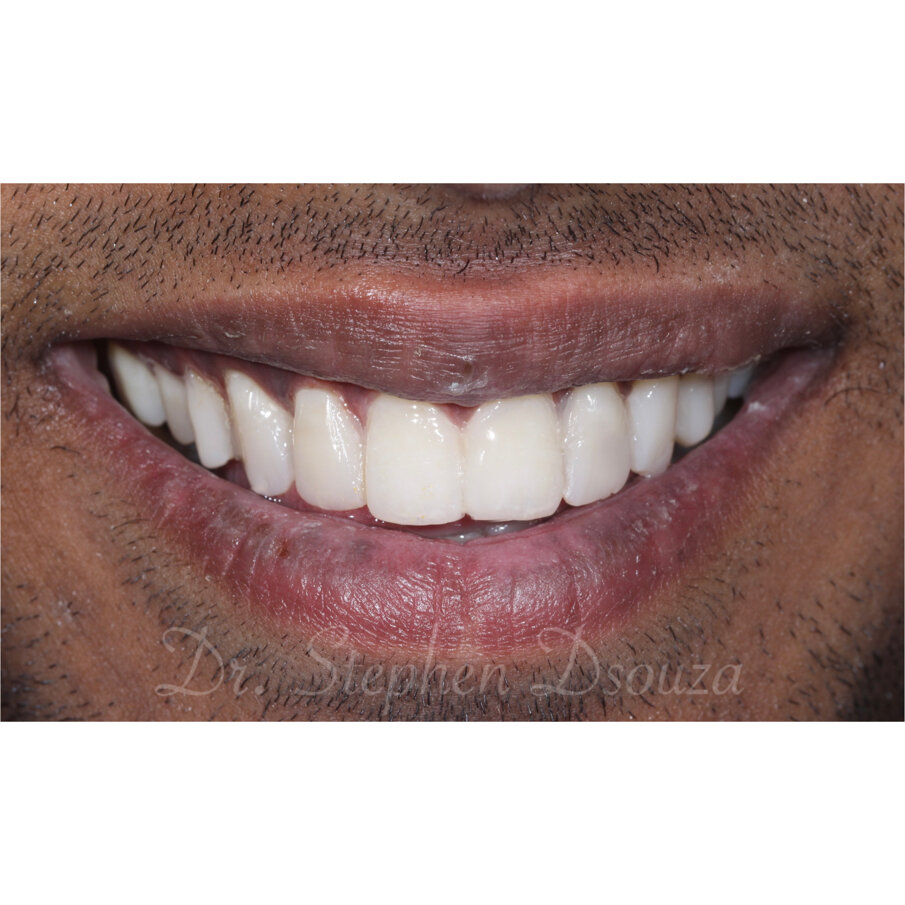 Fig. 9 Postoperative smile frontal view