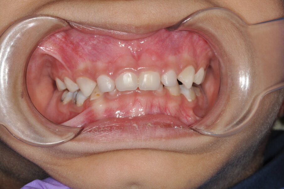 Fig. 9: Front teeth restored with edelweiss pediatric crowns.