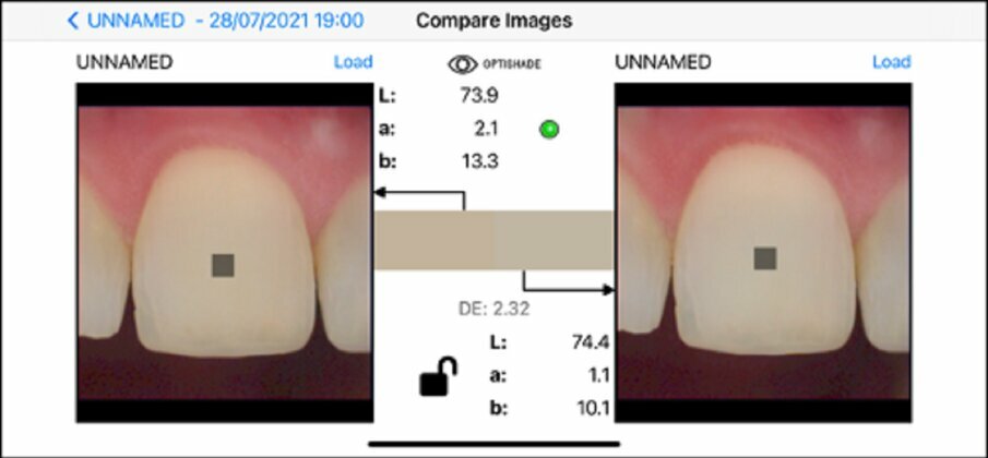 Fig. 11f: Same tooth, *different surface (not clean), same time frame, same positioning, same device, same background. Shade difference: 2.32. Unreliable measurement. The asterisk indicates the parameter critical to the reliability of the measurement.