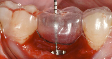 Achieving anatomical shape, support and colour with an Atlantis patient-specific abutment