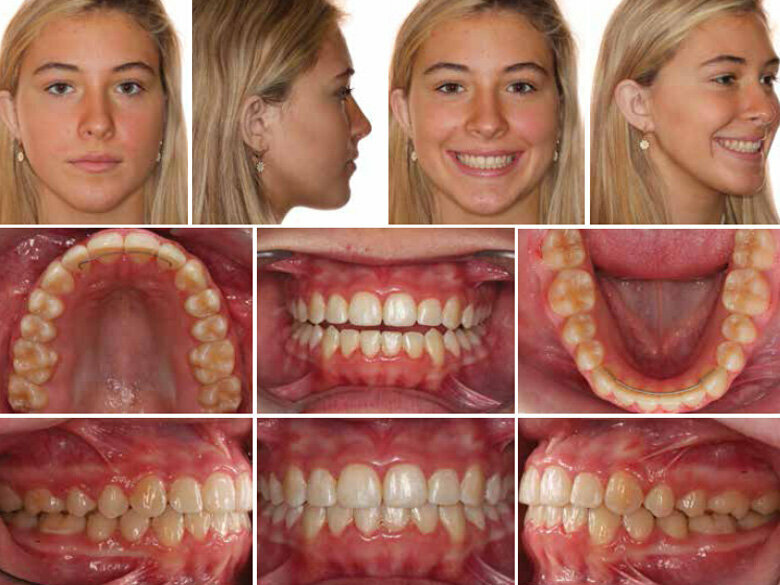 Fig. 2: Two months post 0.014 x 0.0275 CuNiTi Combee wire. (Photos: Michael J. Mayhew, DDS, MS, MS, & Nicole R. Scheffler, DDS, MS)