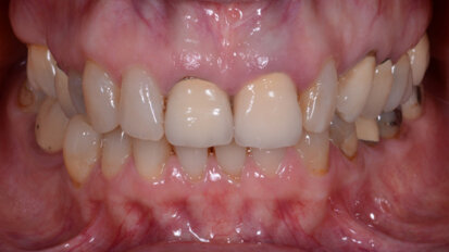 Restoring multiple teeth with a single multilayer zirconia