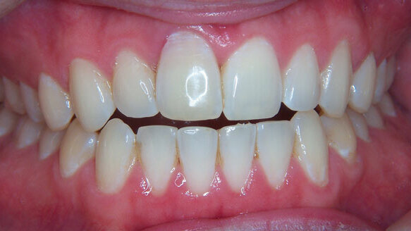 Immediate implantation and provisionalization: Single-tooth restoration in the esthetic zone