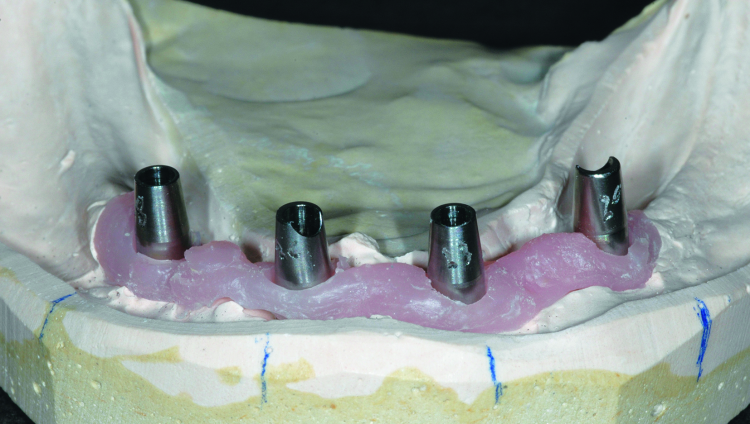 Fig. 8: Atlantis Conus Abutments on the working cast. Each abutment has the tooth number location scribed on the buccal-facing surface.