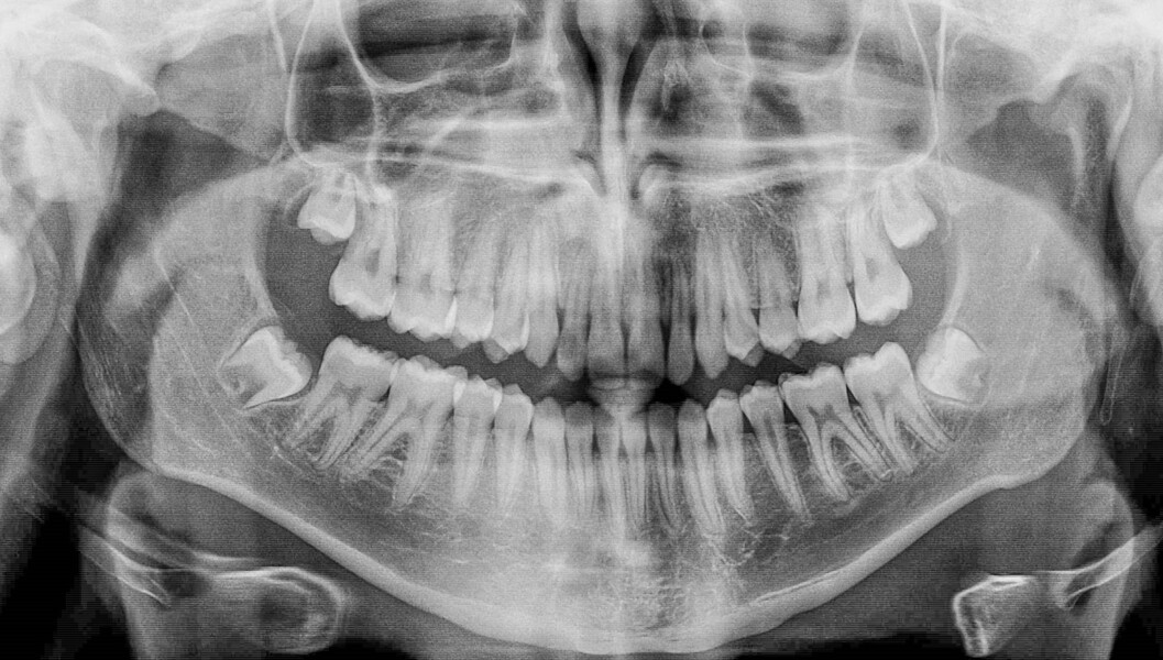 Fig. 8: Panoramic image showing the maxillary right canine fully erupted.