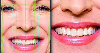 Aesthetic Digital Smile Design: Software-aided aesthetic dentistry—Part II