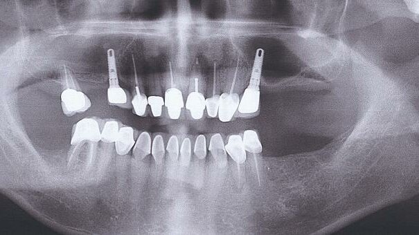 Prevention of failures in oral implantology