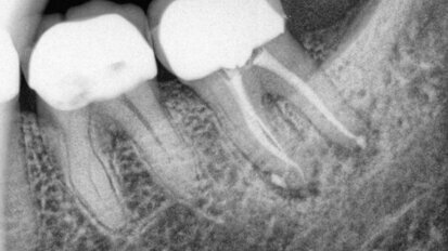 השפעת הארכת כותרת על שרידות שיניים אחוריות עם טיפול שורש כעבור עשר שנים