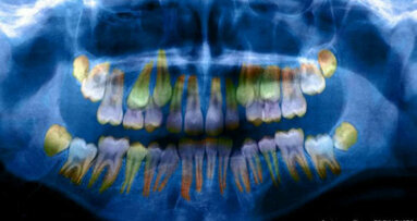 Poziomy stresu jest widoczny w stanie zębów