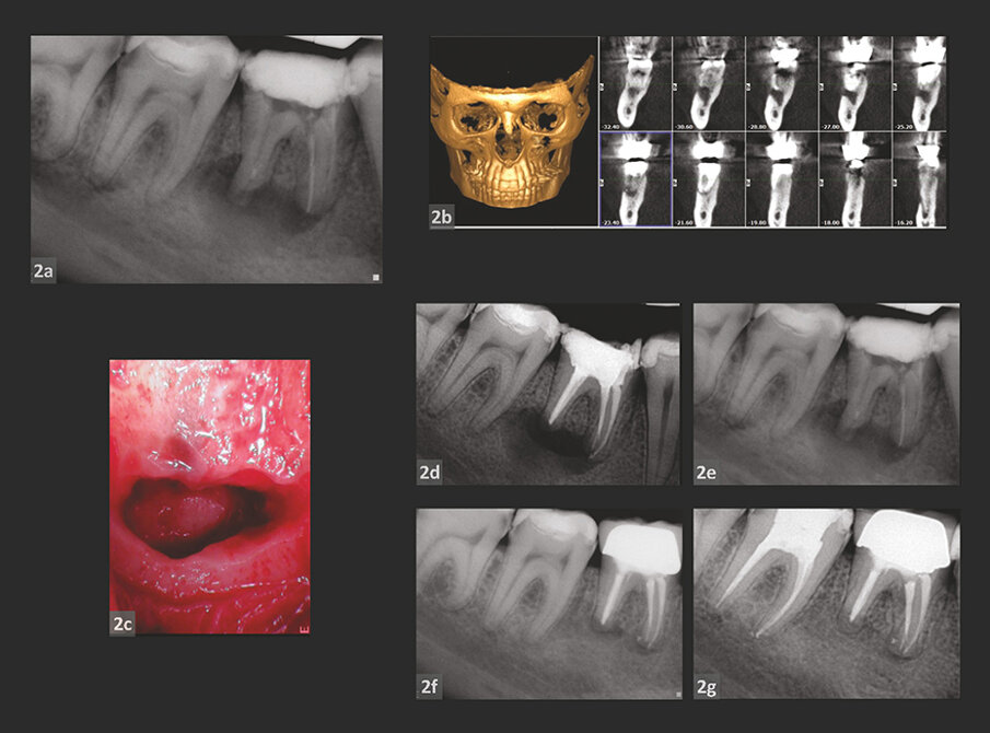 SLUČAJ 2
Slika 2a: Preoperativni periapikalni RTg snimak.
Slika 2b: CBCT podaci o pacijentu.
Slika 2c: Cistična reakcija u blizini mandibularnog kanala.
Slike 2d i 2e: Postoperativna radiografija neposredno nakon intervencije (d) u poređenju sa
preoperativna rendgenskom slikom (e).
Slika 2f: Jednogodišnje praćenje – Rtg snimak.
Slika 2g: Radiografija nakon dve godine praćenja.
