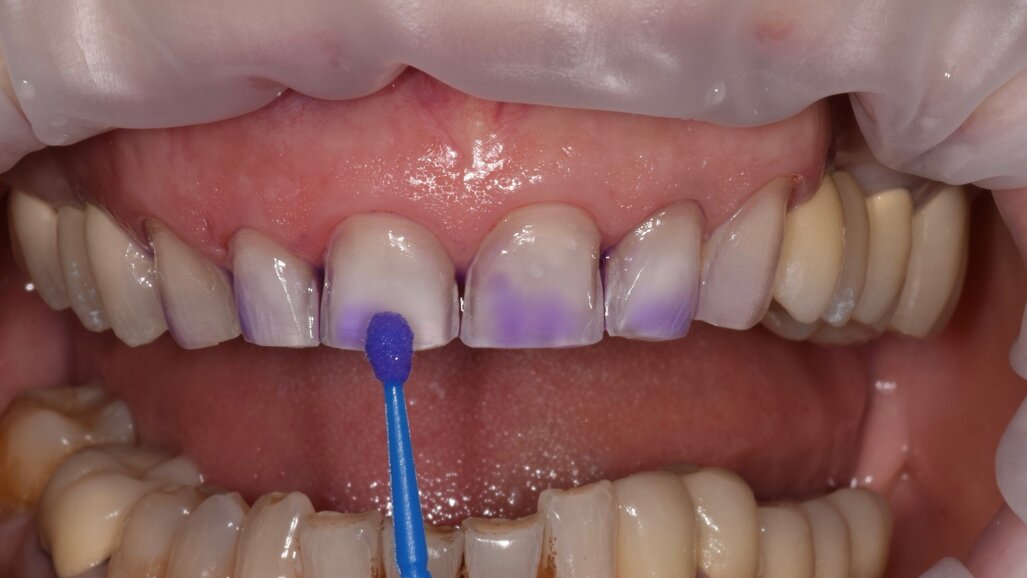Cleaning metal-free fixed dental restorations prior to bonding procedures