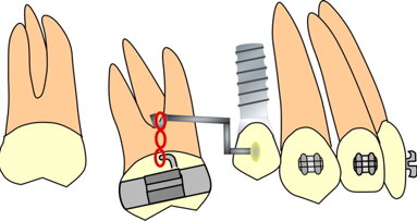 Biomechanics in the orthodontic treatment of complex multidisciplinary problems
