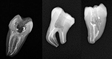 Less-Prep Endo—is a paradigm shift in root canal preparation ahead of us?