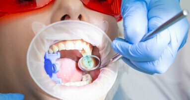Prevalência de cárie dentária continua a afetar adultos australianos, diz estudo