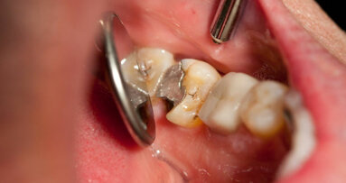 Australian Dental Industry Association advocates ratification of mercury treaty